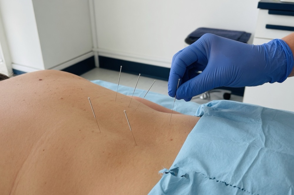 Agujas de acupuntura en la espalda durante una sesión